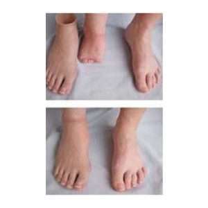 Silicone Partial Foot Prosthesis – Code: EME – 100