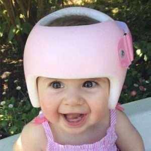 Custom made cranial helmet for plagiocephaly – Code: EME – 159