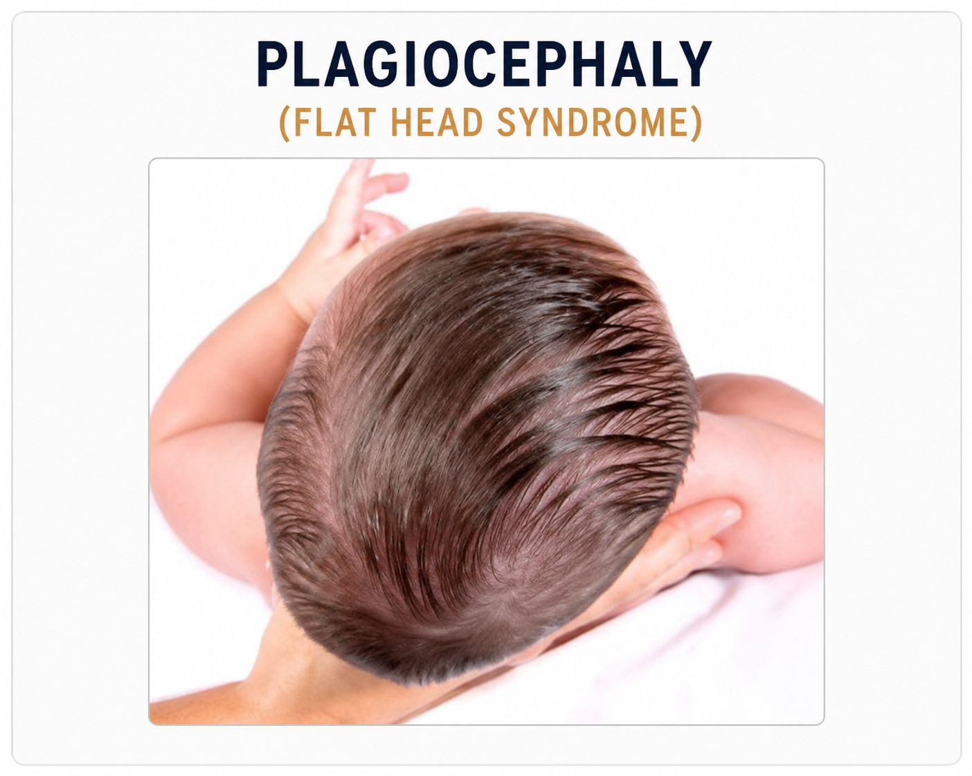 Plagiocephaly flat head syndrome baby