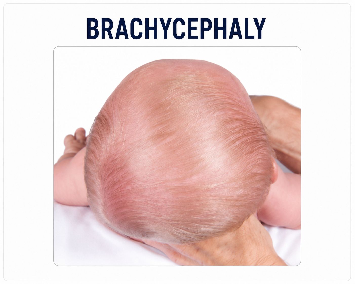 Brachycephaly baby head shape